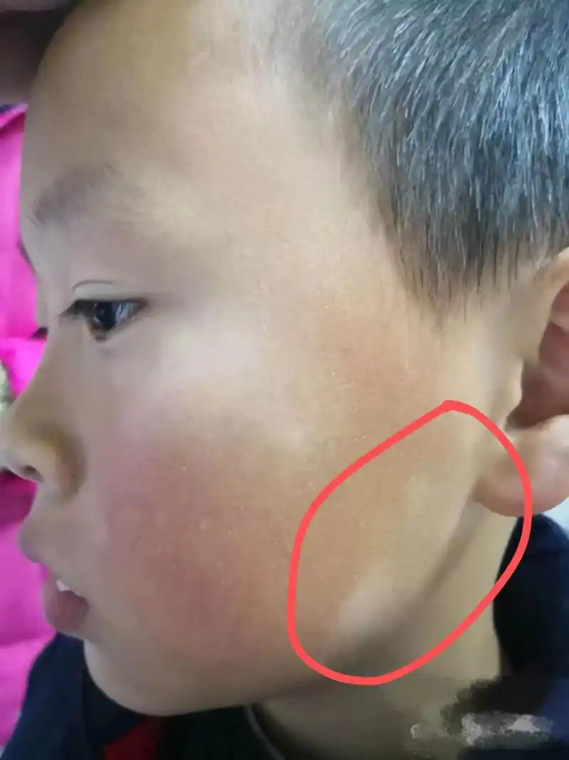 最近又很多问的, "我们孩子脸色突然有一块白白地方,和周边皮肤不一样