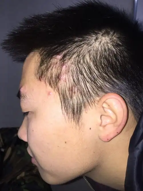 头皮上长痘痘