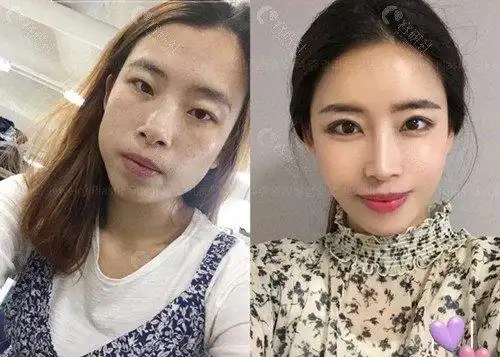 韩国珠儿丽整形外科做眼睑下至对比图