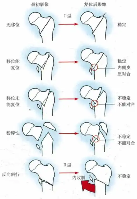 evans分型定义了稳定骨折与不稳定骨折.
