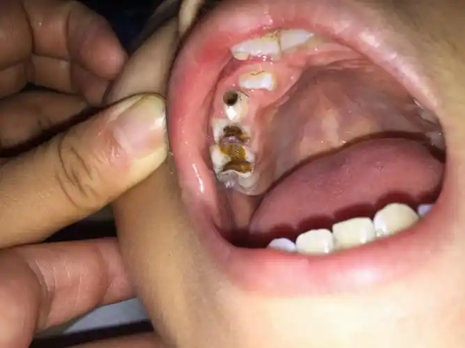 父母晒孩子双排牙齿,还以为是孩子"发育好",网友:赶紧送医院