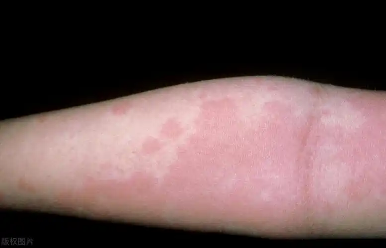 治荨麻疹的药 治疗荨麻疹的特效药-千百号