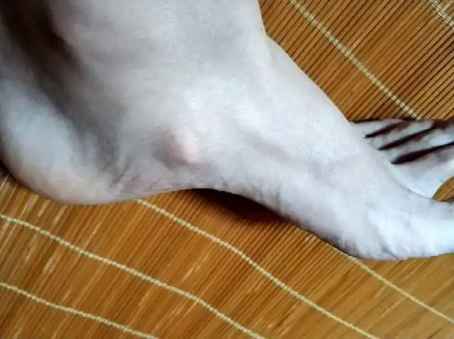 突然发觉左脚一块骨头突出来了,吓人