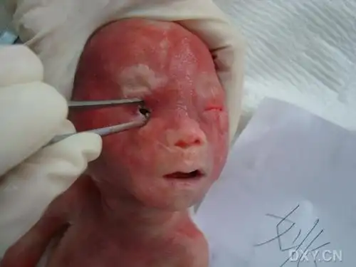 【共享】典型胎儿引产后图片