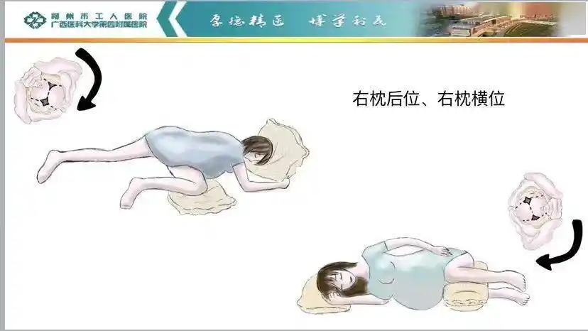 想自然分娩胎位不正怎么办专家告诉你