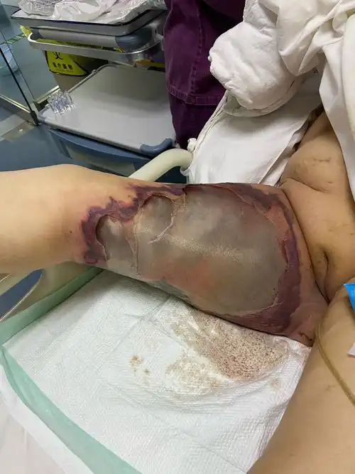 一例极速进展性皮肤坏死病例分享