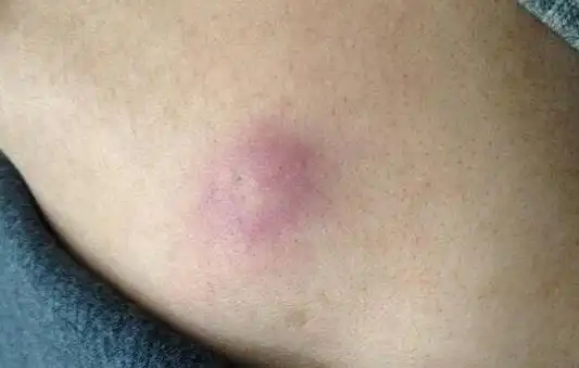 粉瘤早期图片症状