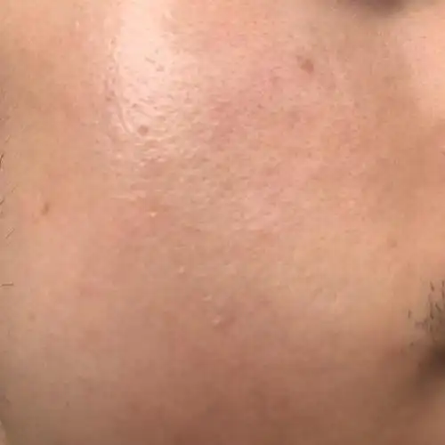 请问我脸上是皮肤角质层厚还是皮肤受损.我然后怎么补水都补不了怎么