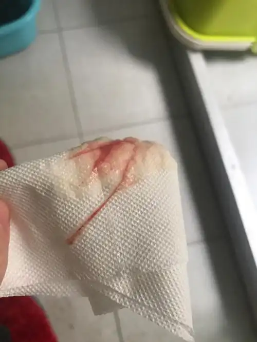 同房后,白带有血丝了,什么情况造成的?(月经还没来)