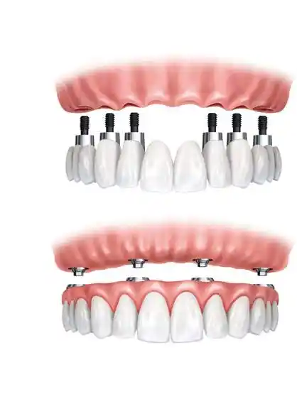 全口牙种植效果怎么样