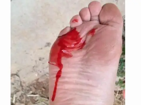 梦见自己脚受伤流血