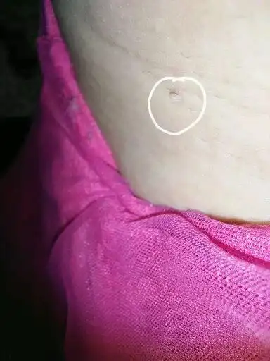 腋下长小肉粒:腋下长出莫名其妙的小肉粒不痛不痒