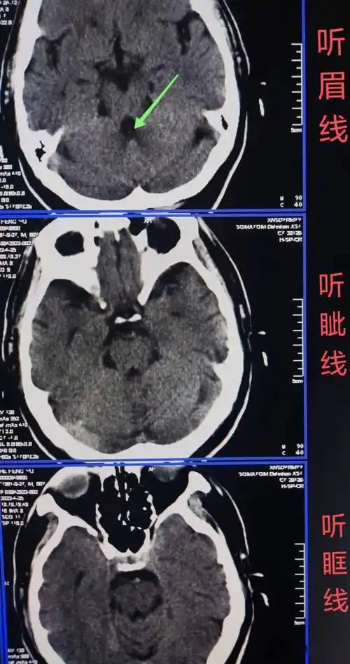 头颅ct扫描时如何打角度才能看得更多更清晰