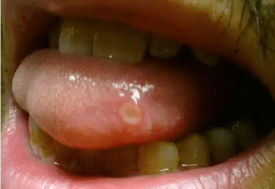 厦门舌头溃疡主要有哪些表现