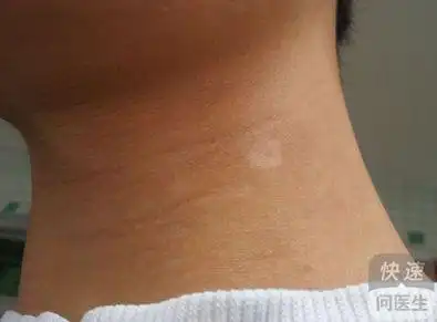 白斑病为什么不容易被治好 得了白癜风到底该怎么治疗