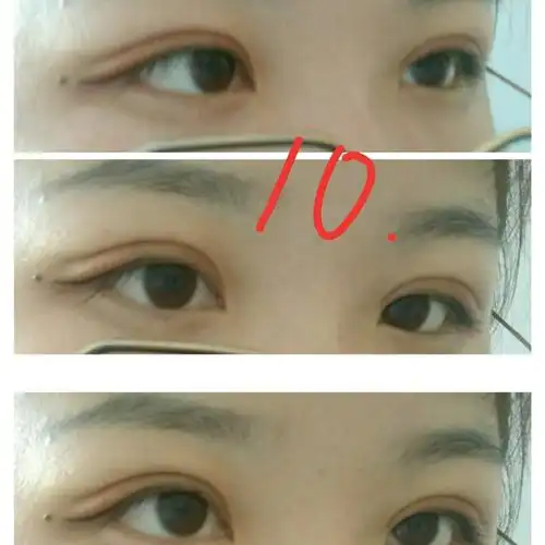 埋线双眼皮第10天