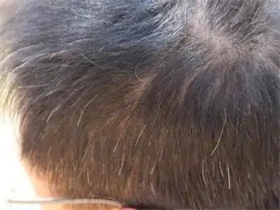 但是如果家里宝宝的白发越来越多,出现成片白发的情况就需要引起家里