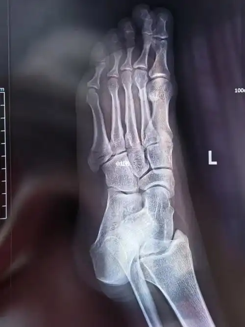 第5跖骨基地部破裂骨折第一天