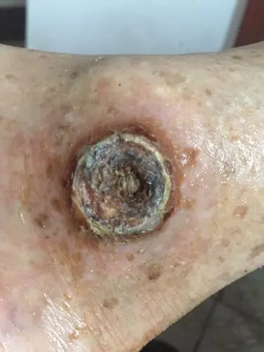 我爷爷脚踝有个洞…….