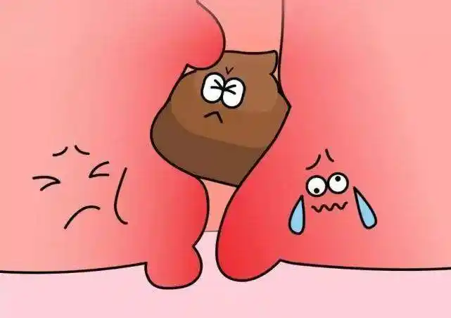 五大症状提示你可能得了痔疮