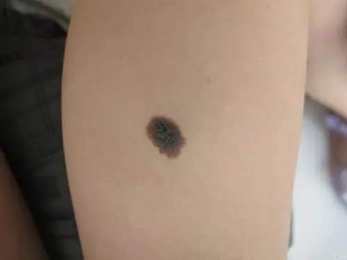 病例更新,附病理结果,皮肤镜结果扫描中.