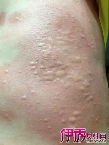 【图】过敏荨麻疹图片展示 5大症状你了解多少