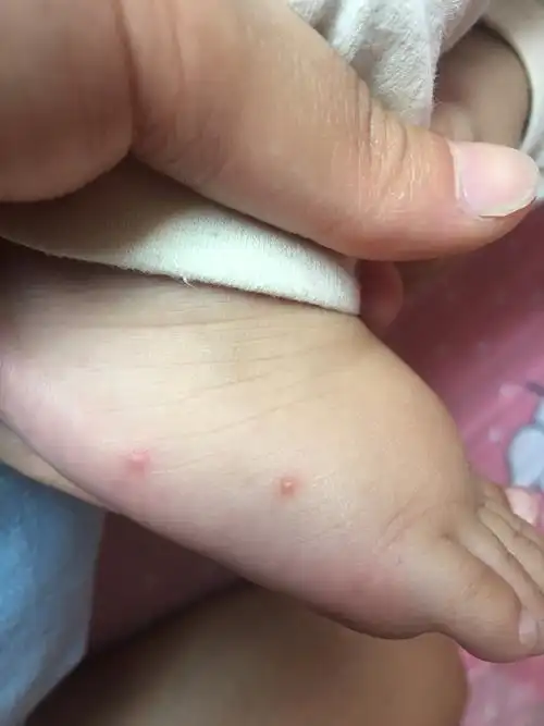 宝宝身上长水泡擦什么药好