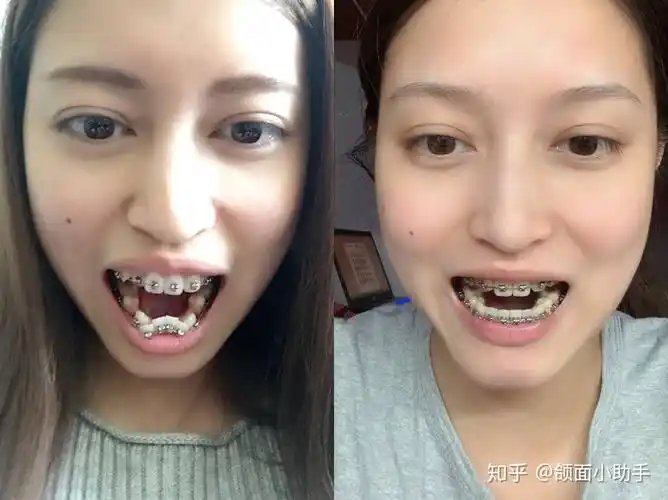 正畸拔牙对身体有副作用吗