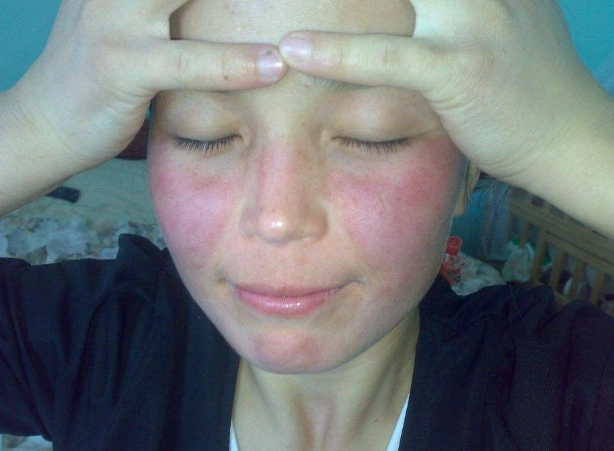 皮肤过敏图片大全 (55)