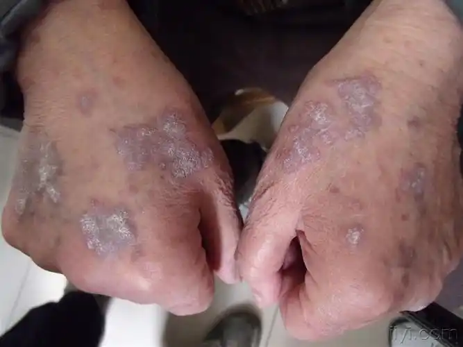 红斑狼疮合并银屑病-门诊照片