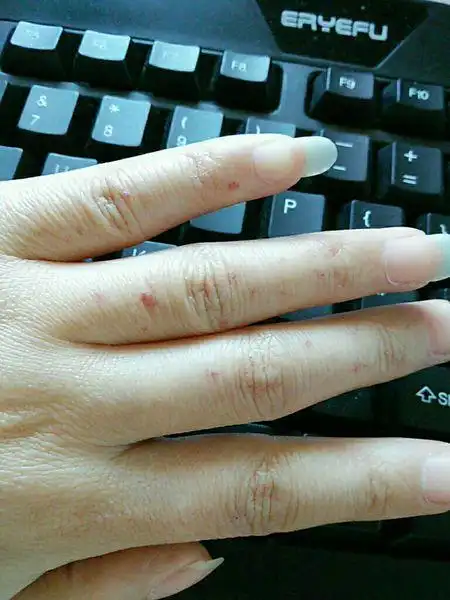 手指上很多红色小点,按住就消失,松开又有,检查说是蜘蛛痣,可我的肝