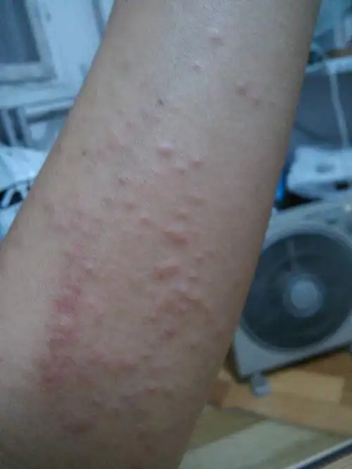 请问这是什么症状,是什么皮肤过敏吗?