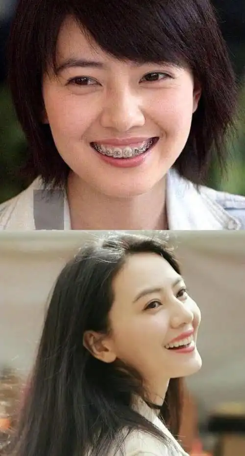 刘亦菲的牙齿和年轻时候不一样(说刘亦菲牙齿丑的)(27)