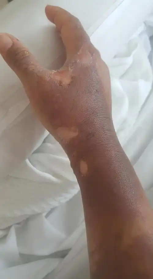 原因是被「这一瓶」喷到并严重灼伤