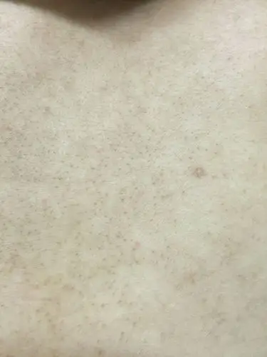 背上的黑头怎么去求方法