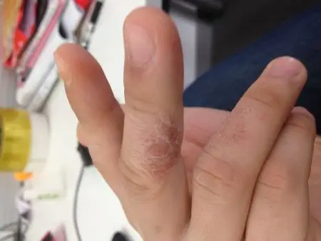 (图)我手指痒痒的脱皮怎么回事儿?