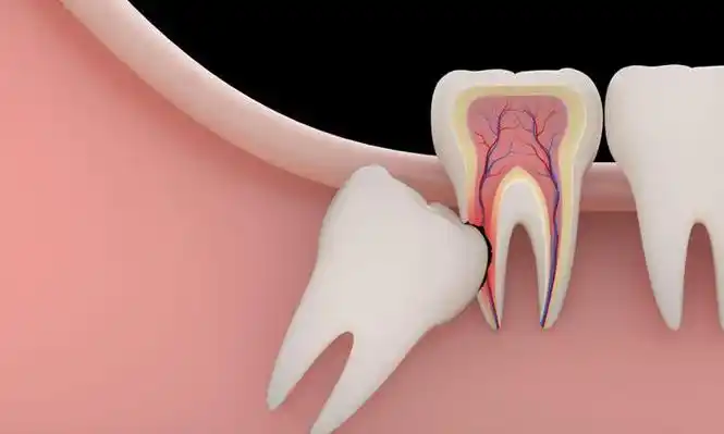 支招 | 你的智齿到底要不要拔?