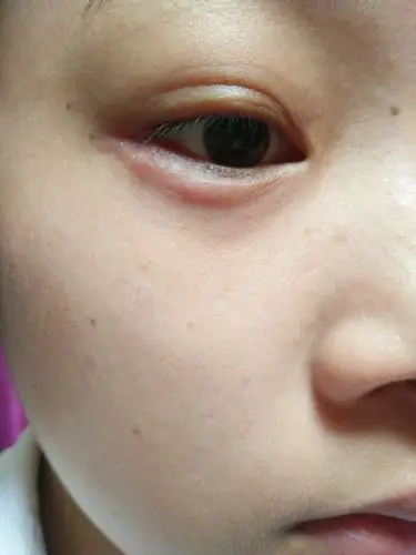 前天起床的时候眼睛下眼皮有点疼,今天厉害了,都鼓起来了,还疼,不知道