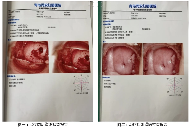 这次有出血症状,她在网上查到:绝经后出血,不排除宫颈癌和子宫内膜癌