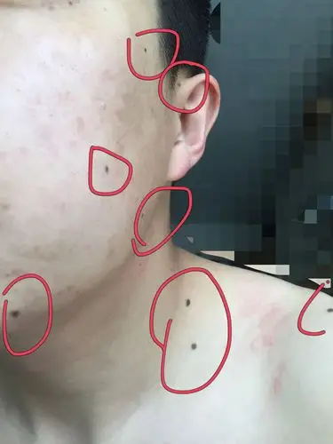 想请教专业人士,身上长痣什么原因?