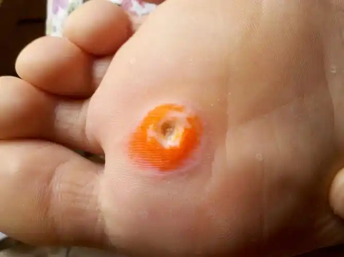 脚上长了个鸡眼,本来就一点点大,然后不想去医院