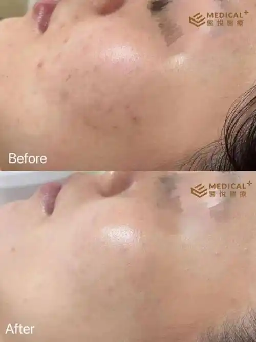 毛孔更细腻,脸部皮肤更加透亮有光泽,暗沉痘印减淡,闭口痘痘消退很多