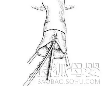 医学图解:包皮手术全过程