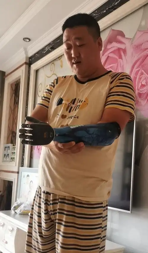 上肢假肢的真实案例