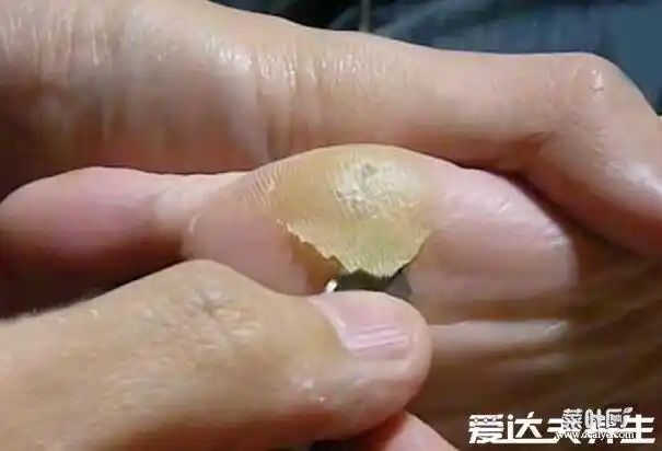 鸡眼挖出来的肉刺图,呈淡黄有倒圆锥状的角质一定要挖干净
