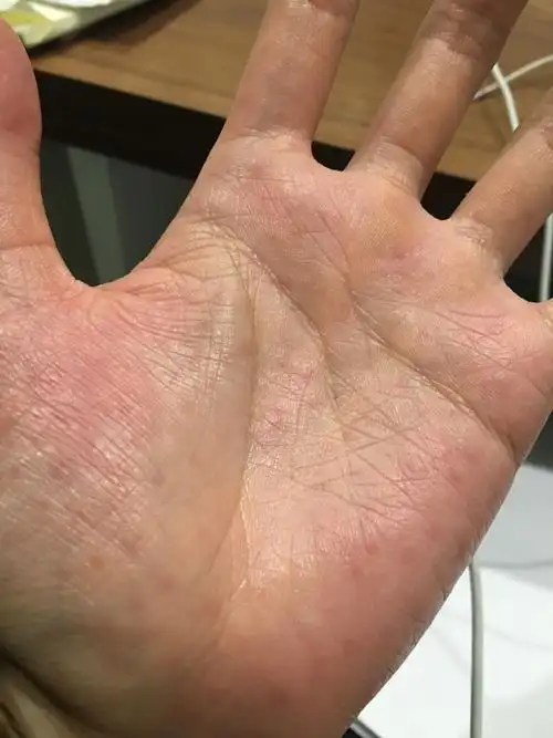 前段时间老是出手汗,然后就成这样了,这是湿疹吗,还蜕皮,一个一个的圈