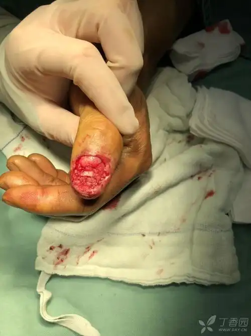 这样甲床缺损怎么治疗? [病例帖]