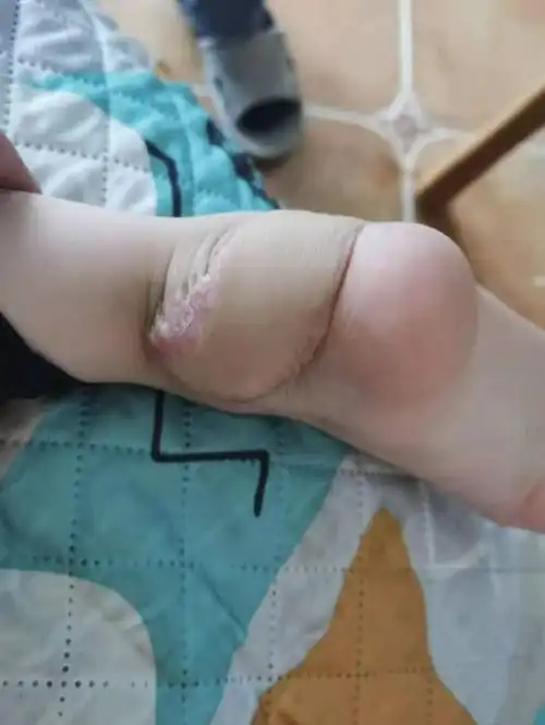 女士女儿受伤的右脚