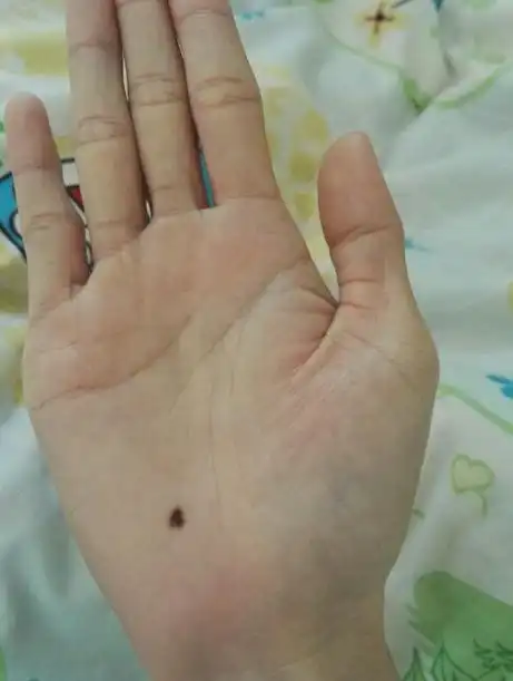 女生右手手掌有痣(女生右手掌上的痣好吗)