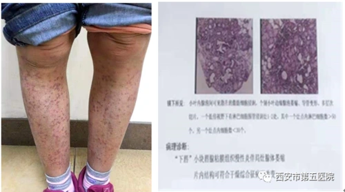 风湿病中的伪装者认识干燥综合征